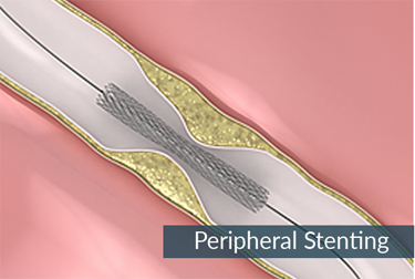 Peripheral-Stenting