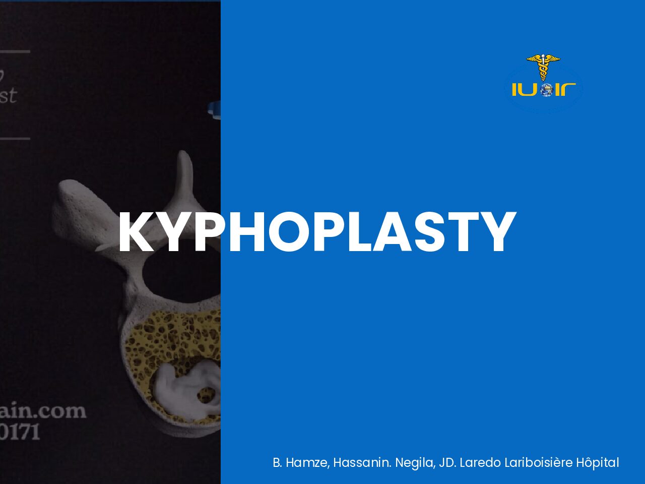 kyphoplastie
